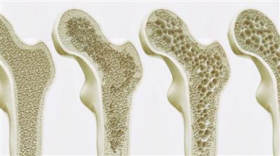 دراسة: أكثر من 200 مليون شخص يعانون من هشاشة العظام