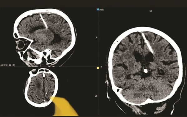 أطباء يعثرون على «إبرة» في دماغ مسنة منذ 80 عاماً