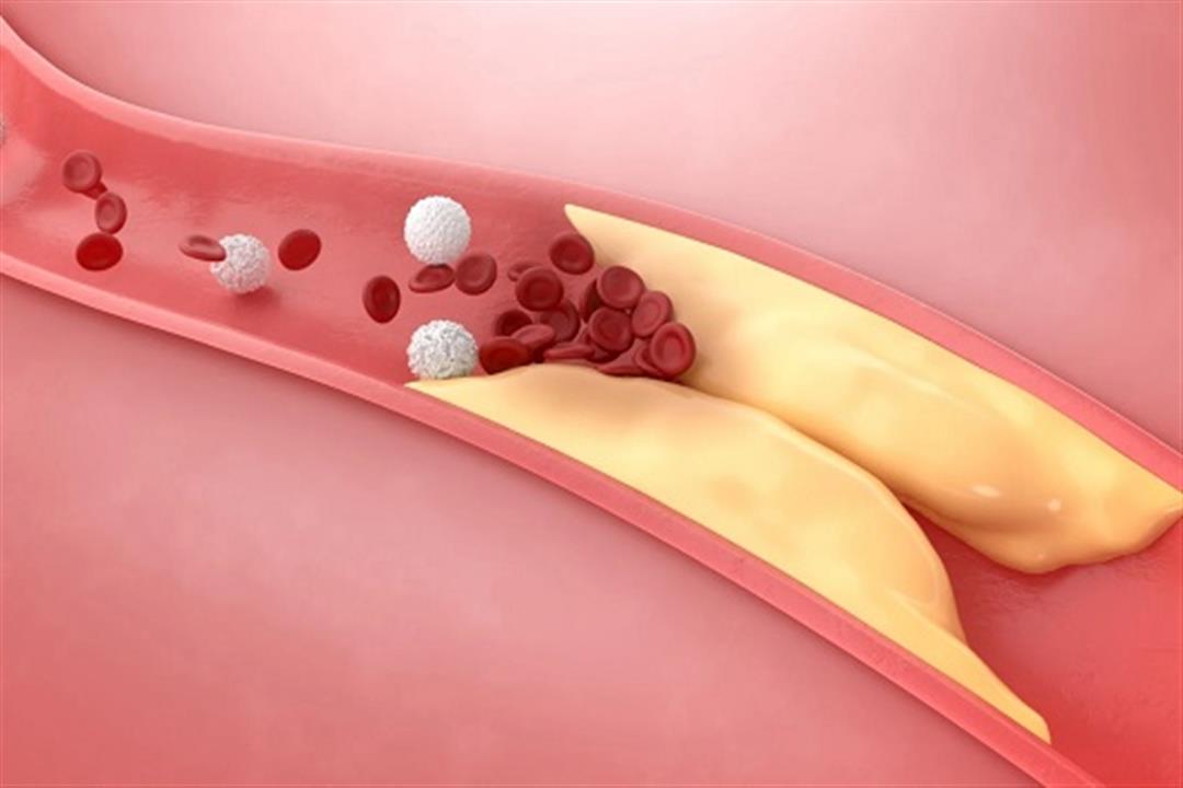 بعد الستين- 7 علامات لارتفاع الكوليسترول عند النساء